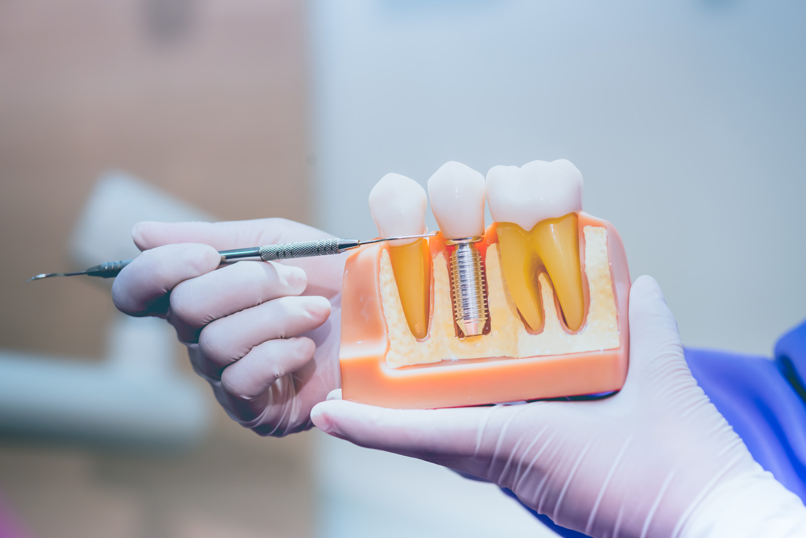 A gloved hand pointing to a cutaway model showing an implant post anchored in the jawbone beside natural tooth roots