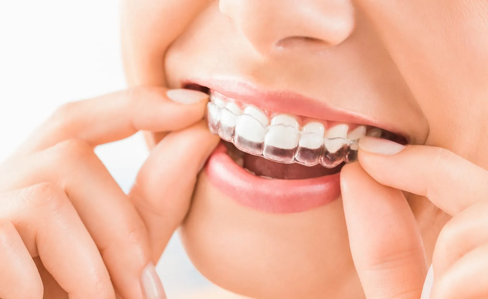 A clear aligner being fitted over the upper teeth