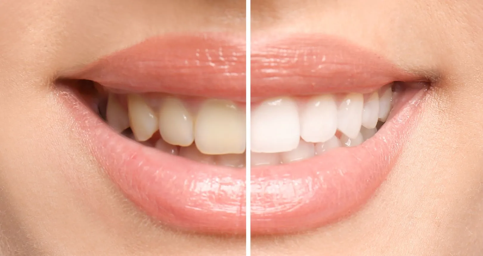 A smile split down the middle, yellowed teeth on the left and noticeably whiter teeth on the right